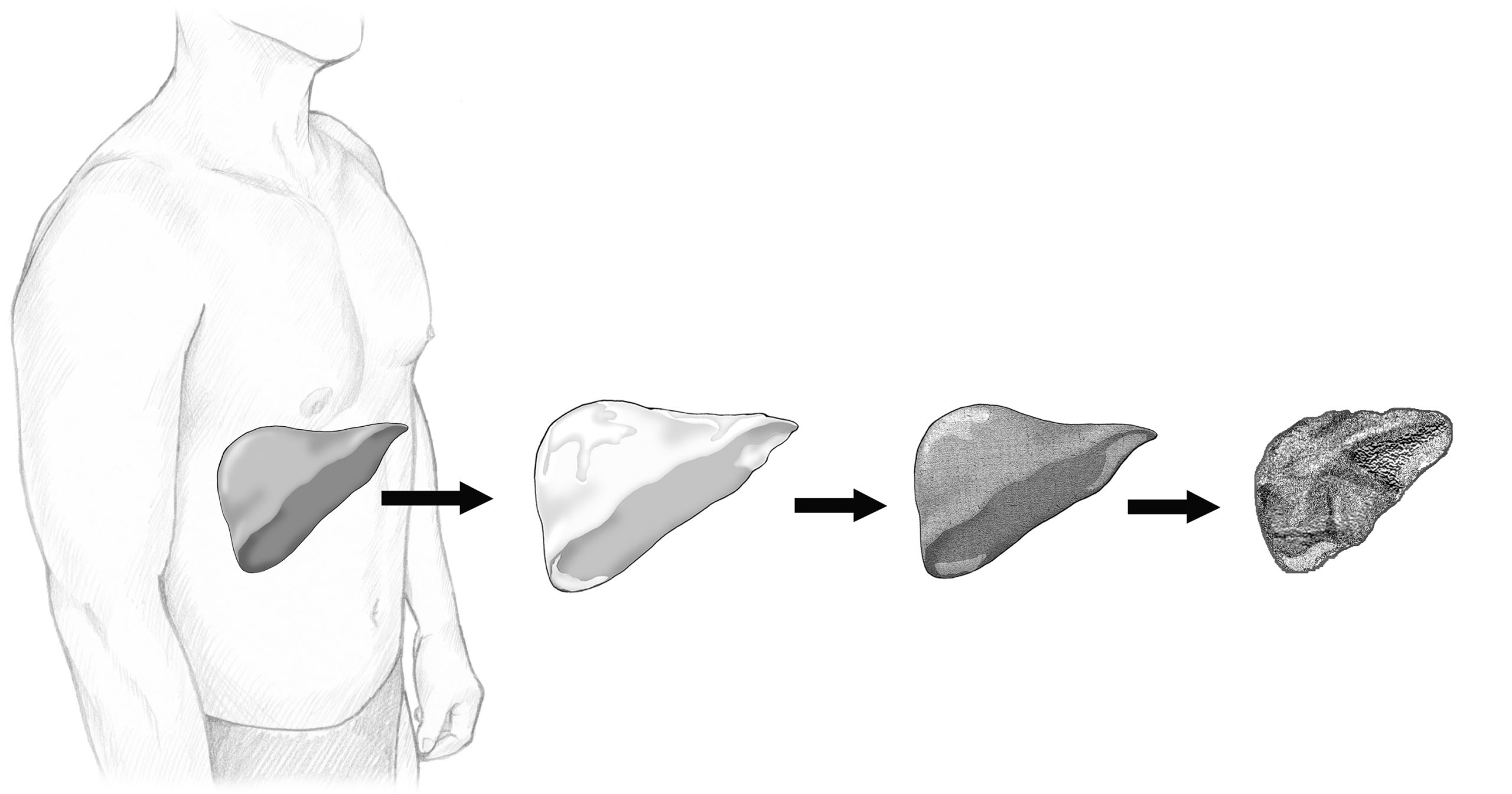 Liver damage illustration
